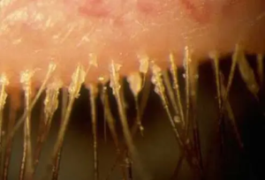 Demodex Blepharitis