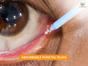 Punctal Plugs