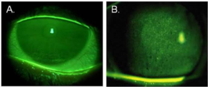 Dry Eye Corneal Staining