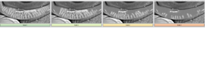 Meibography for oil glands