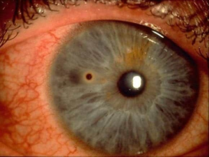 Metal in Eye